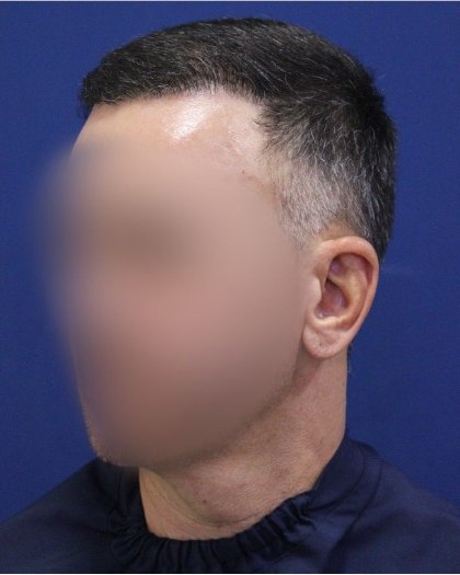 Fotografia de acompanhamento depois do tratamento: a mesma vista de três quartos, com a entrada preenchida e cabelo aparado