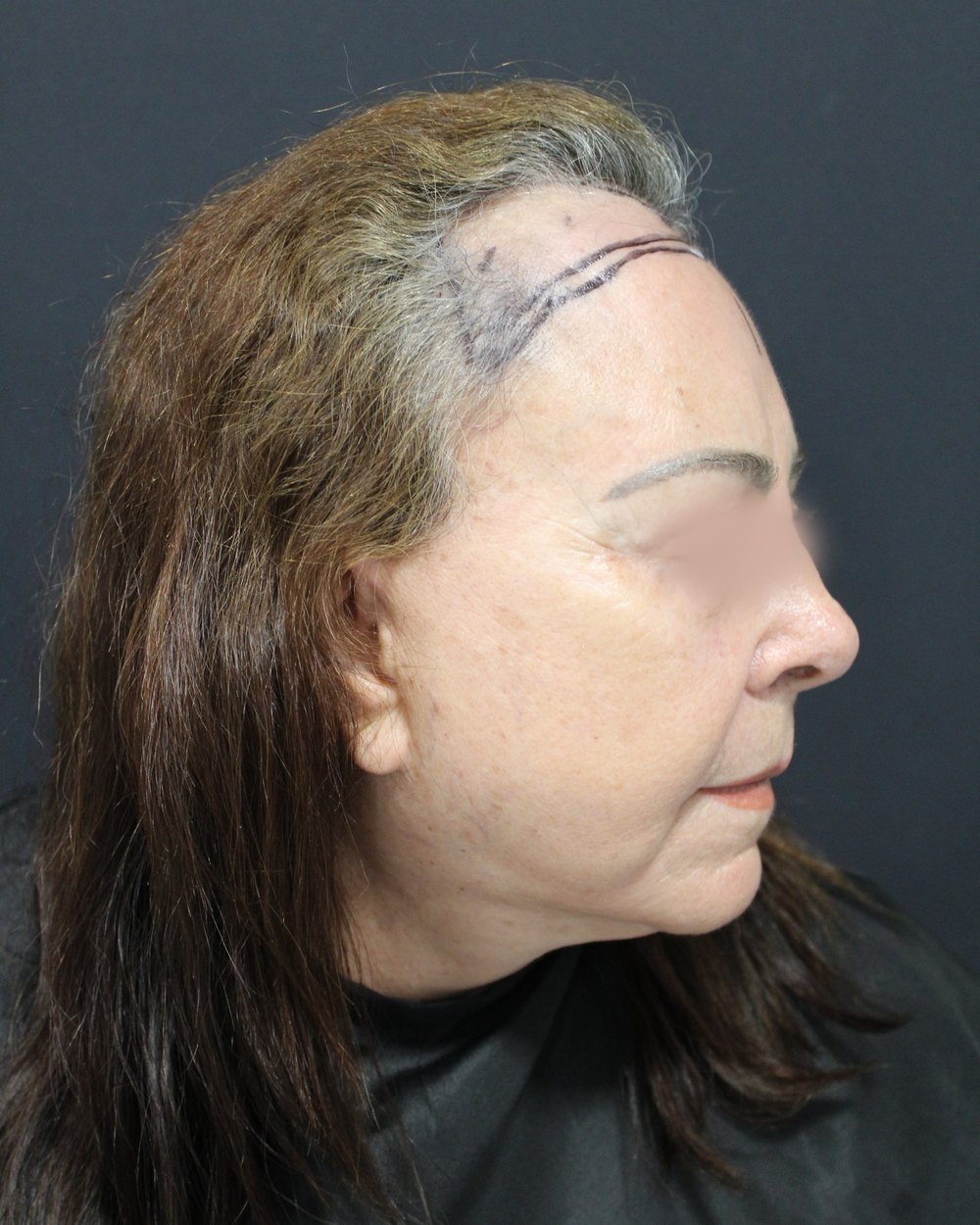 Fotografia de acompanhamento antes do tratamento: vista lateral de três quartos da linha do cabelo de paciente mulher, com marcação cirúrgica na região frontal