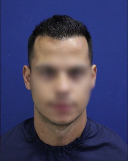 Fotografia de acompanhamento depois do tratamento: a mesma vista frontal, com cabelo mais denso e linha preenchida
