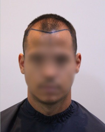 Fotografia de acompanhamento antes do tratamento: vista frontal da linha do cabelo de paciente, com cabelo curto e marcação cirúrgica